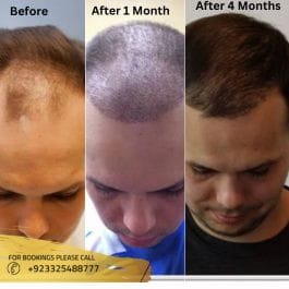 FUE Hair Transplant Results Month by Month