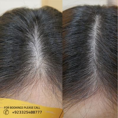 How Soon Can I See the Results of Exosomes Hair Treatment