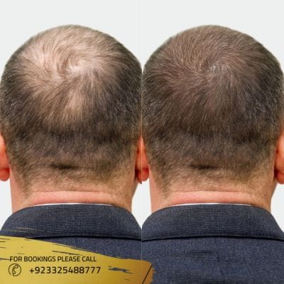 FUE Hair Transplant Results Month by Month