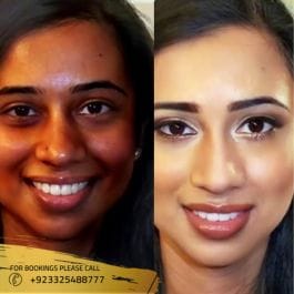 Skin Whitening Injection Photos