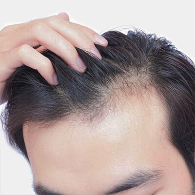 Best Hair loss Treatment Cost in Islamabad