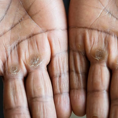 How Long Do Warts Last Without Treatment?