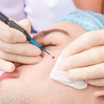 Laser Warts Removal Cost in Islamabad Pakistan