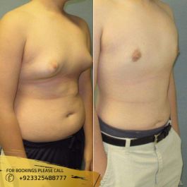 Weight loss treatment in islamabad, pakistan