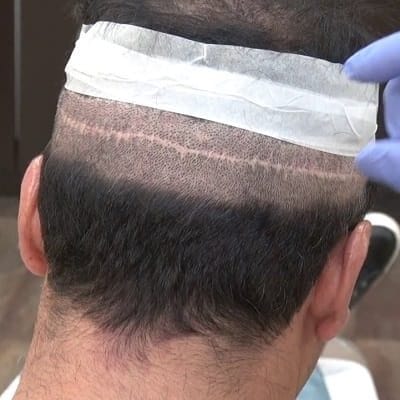 Would scarring after a hair transplant be visible?