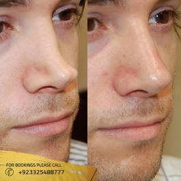 results of Non-Surgical Nose Job cost in islamabad