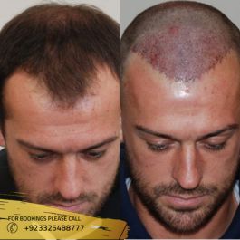 Before & After Hair Transplant photos