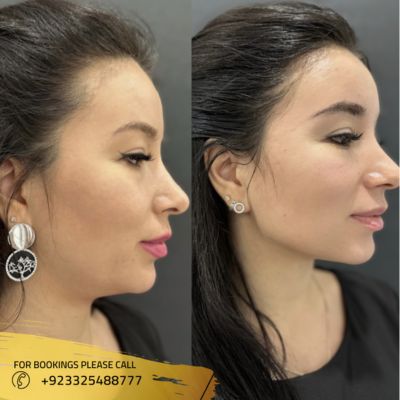 Before After Results of Dermal Fillers in Islamabad