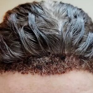 Can A Hair Transplant Go Wrong?