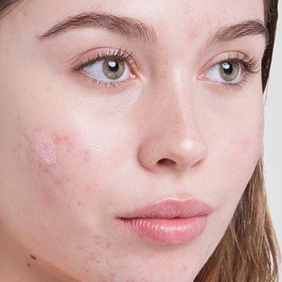 Cost of Acne Scar Treatment in Islamabad