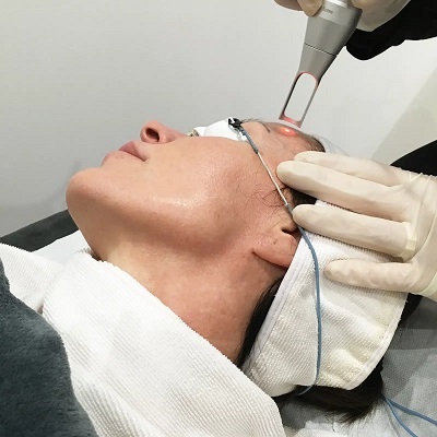 Does Pico Laser Treatment Remove Facial Hair on the Face?