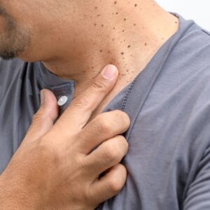 Does skin tags removal treatment leave scars on the skin?