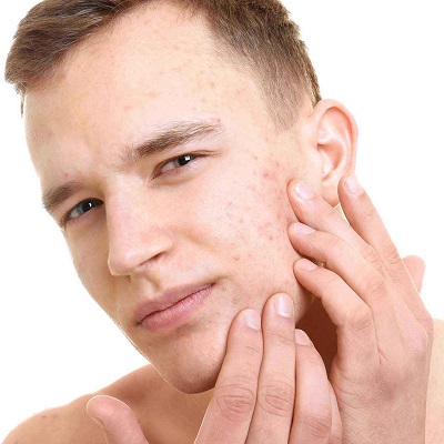 How Many Months Will Acne Scars Take to Fade Away?