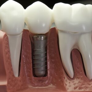 How Many Stitches After a Dental Implant?