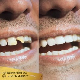 Results of Dental Fillings in Islamabad