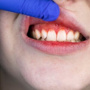 What happens when gums grow on overlapping teeth?