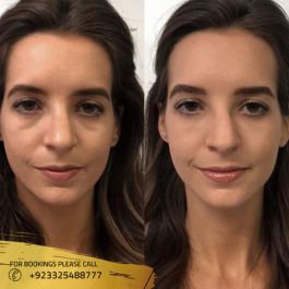 before after photos of dermal fillers