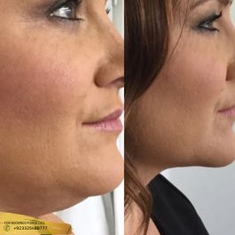 chin fat dissolving injections before and after