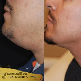 chin liposuction before and after male