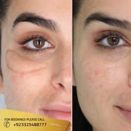 dermal fillers before after results in islamabad pakistan