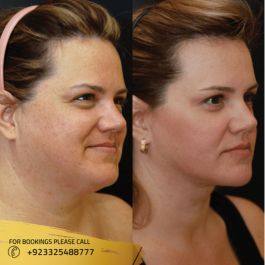 double chin liposuction cost