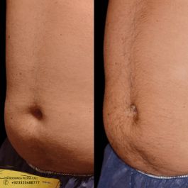 fat melting injections before after belly fat