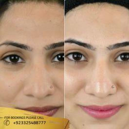 glutathione injection for skin whitening before and after