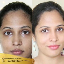 glutathione injection before and after