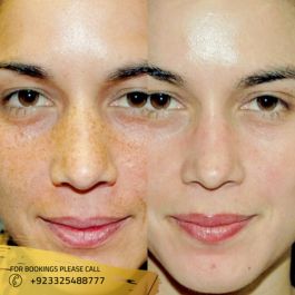 hydrafacial treatment results in islamabad, pakistan