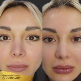 results of dermal fillers in islamabad