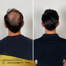 Best Hair Transplant results near me