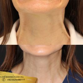 Neck results of Botox In Islamabad