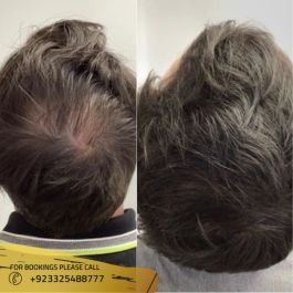 PRP hair Treatment cost in Islamabad pakistan