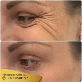 botox injection before after results eyes