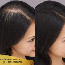 female hair transplant in Islamabad , Pakistan