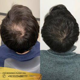 prp before after results male