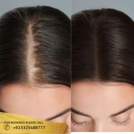 prp before and after hair female