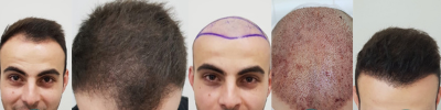 results of hair transplant near me