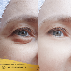 Cost of Eyelid surgery in Pakistan