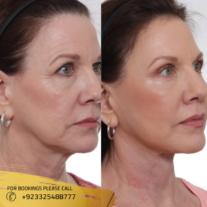 cost of facelift in islamabad pakistan
