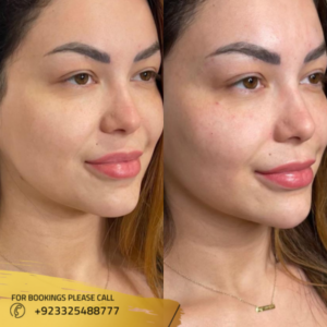 dermal fillers before after results in islamabad cost
