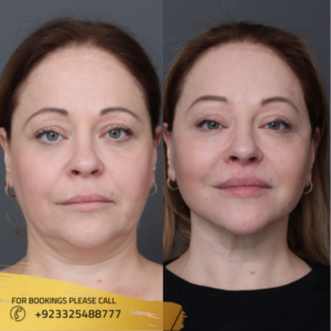 facelift in islamabad pakistan