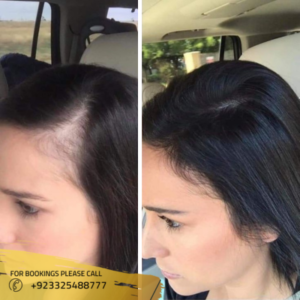 Exosomes Hair therapy Before and after by Dr syeda Huma