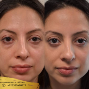 Eyebags removal cost in islamabad