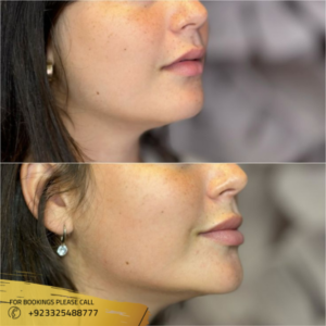 Lemon Bottle Fat Dissolving Injections before after - Dr Maryam Malik