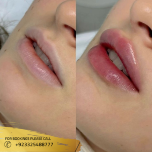 Lip fillers before and after by Dr Syeda Huma