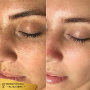 Microneedling in Islamabad