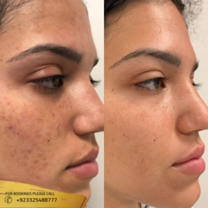 Microneedling in Islamabad, Rawalpindi & Pakistan