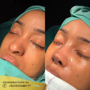 Non Surgical Nose Job before and after - Dr Ayusha Khan