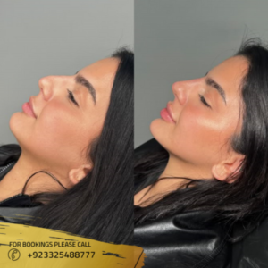 Nose Fillers before and after Dr Syeda Huma